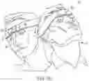 Fig. 03 - Head positioner for retinal surgery patients