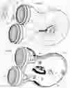 Fig. 04 - METHODS AND DEVICES FOR TREATING PRIMARY HEADACHE