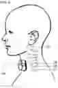 Fig. 08 - METHODS AND DEVICES FOR TREATING PRIMARY HEADACHE