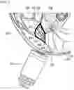Fig. 09 - METHODS AND DEVICES FOR TREATING PRIMARY HEADACHE