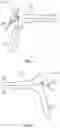 Fig. 02 - Applicator for a speculum accessory sleeve and use thereof