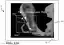 Fig. 22 - Systems and methods for intra-operative pelvic registration