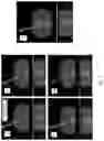 Fig. 08 - Method of needle localization via partial computerized tomographic scanning and system thereof