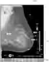 Fig. 01 - Displaying computer-aided detection information with associated breast tomosynthesis image information