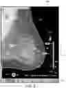 Fig. 06 - Displaying computer-aided detection information with associated breast tomosynthesis image information