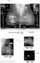 Fig. 09 - Displaying computer-aided detection information with associated breast tomosynthesis image information