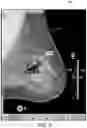 Fig. 10 - Displaying computer-aided detection information with associated breast tomosynthesis image information