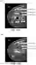 Fig. 11 - Displaying computer-aided detection information with associated breast tomosynthesis image information