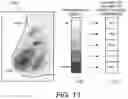 Fig. 13 - Displaying computer-aided detection information with associated breast tomosynthesis image information