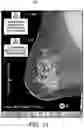 Fig. 14 - Displaying computer-aided detection information with associated breast tomosynthesis image information