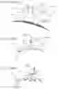 Fig. 161 - METHODS AND DEVICES TO DECREASE TISSUE TRAUMA DURING SURGERY