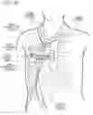 Fig. 96 - METHODS AND DEVICES TO DECREASE TISSUE TRAUMA DURING SURGERY