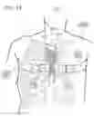 Fig. 97 - METHODS AND DEVICES TO DECREASE TISSUE TRAUMA DURING SURGERY
