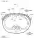 Fig. 98 - METHODS AND DEVICES TO DECREASE TISSUE TRAUMA DURING SURGERY
