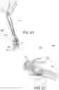 Fig. 12 - Methods of making reinforced soft tissue grafts with suture loop/needle constructs