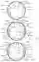 Fig. 11 - Reinforced deformable anvil tip for surgical stapler anvil