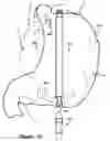 Fig. 20 - Polymer overmolded bariatric clamp and method of installing