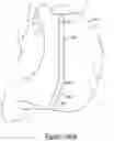 Fig. 67 - Polymer overmolded bariatric clamp and method of installing