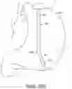 Fig. 68 - Polymer overmolded bariatric clamp and method of installing