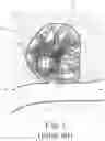 Fig. 02 - Intrasaccular aneurysm occlusion device with net or mesh expanded by string-of-pearls embolies