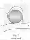 Fig. 03 - Intrasaccular aneurysm occlusion device with net or mesh expanded by string-of-pearls embolies