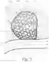 Fig. 04 - Intrasaccular aneurysm occlusion device with net or mesh expanded by string-of-pearls embolies