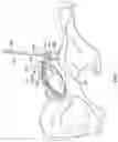 Fig. 09 - PATIENT-SPECIFIC ACETABULAR GUIDES AND ASSOCIATED INSTRUMENTS