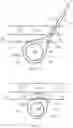 Fig. 28 - Causing ischemia in tumors
