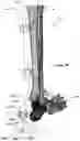 Fig. 43 - Anatomic external fixation system for the ankle