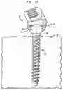 Fig. 09 - Stabilizing Bone Using Spinal Fixation Devices and Systems