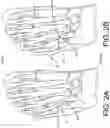 Fig. 03 - Implants and related methods for bunion correction