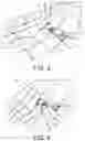 Fig. 04 - Implants and related methods for bunion correction