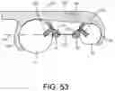 Fig. 48 - Implants and related methods for bunion correction