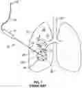 Fig. 02 - Bronchoscopic-based microwave ablation system and method