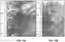 Fig. 13 - Bronchoscopic-based microwave ablation system and method