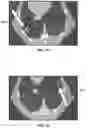 Fig. 15 - Bronchoscopic-based microwave ablation system and method