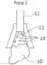 Fig. 01 - METHOD OF REDUCING STONE FRAGMENTS TO DUST DURING LASER LITHOTRIPSY