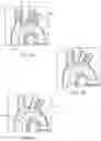 Fig. 02 - Accessory device to provide neuroprotection during interventional procedures
