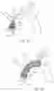 Fig. 04 - Accessory device to provide neuroprotection during interventional procedures