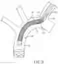 Fig. 07 - Accessory device to provide neuroprotection during interventional procedures