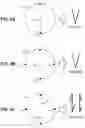 Fig. 04 - INTRAOCULAR LENS SYSTEM WITH FOLDING FEATURES