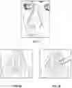 Fig. 02 - Nasal implants, delivery tools, systems, and methods of use