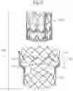 Fig. 09 - Surgical methods of replacing prosthetic heart valves