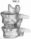 Fig. 08 - INTERBODY STANDALONE DEVICE WITH INTEGRATED FIXATIONS
