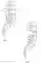Fig. 02 - Intrabody Osteotomy Implant and Methods of Use