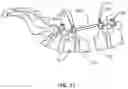 Fig. 09 - Intrabody Osteotomy Implant and Methods of Use
