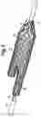 Fig. 07 - Deployment handle with stabilizing rail for a pre-loaded prosthesis delivery device