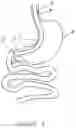 Fig. 02 - Activable bougie for performing gastroplasty