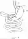 Fig. 04 - Activable bougie for performing gastroplasty