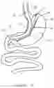 Fig. 05 - Activable bougie for performing gastroplasty